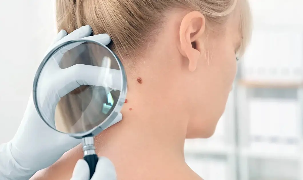 Botox treatment