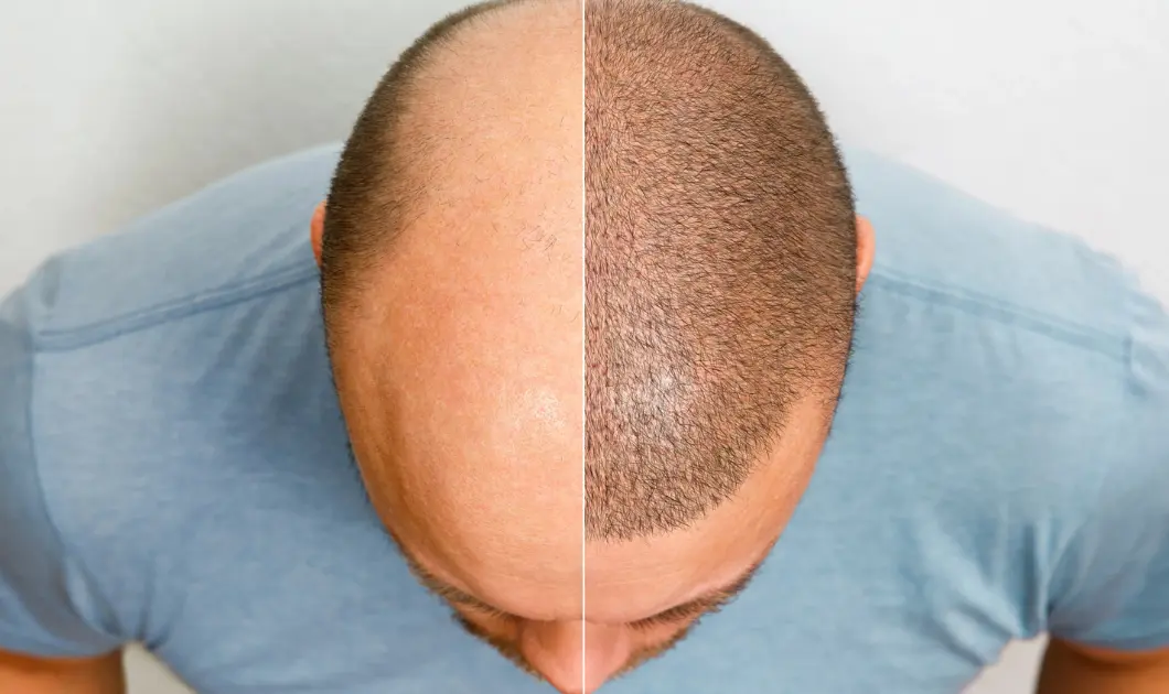 Hair Transplantation
