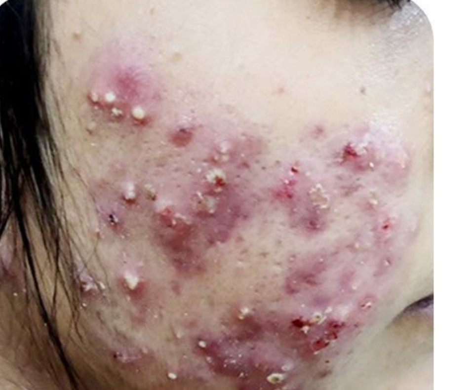 Image of the face showing pimples before treatment