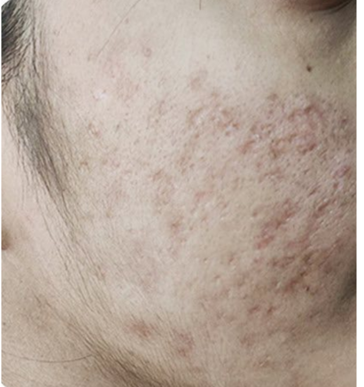 Image of the face showing pimples after treatment