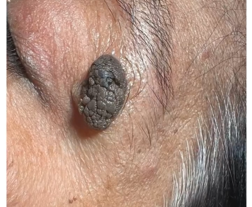 Image of the face before receiving treatment for seborrheic keratosis