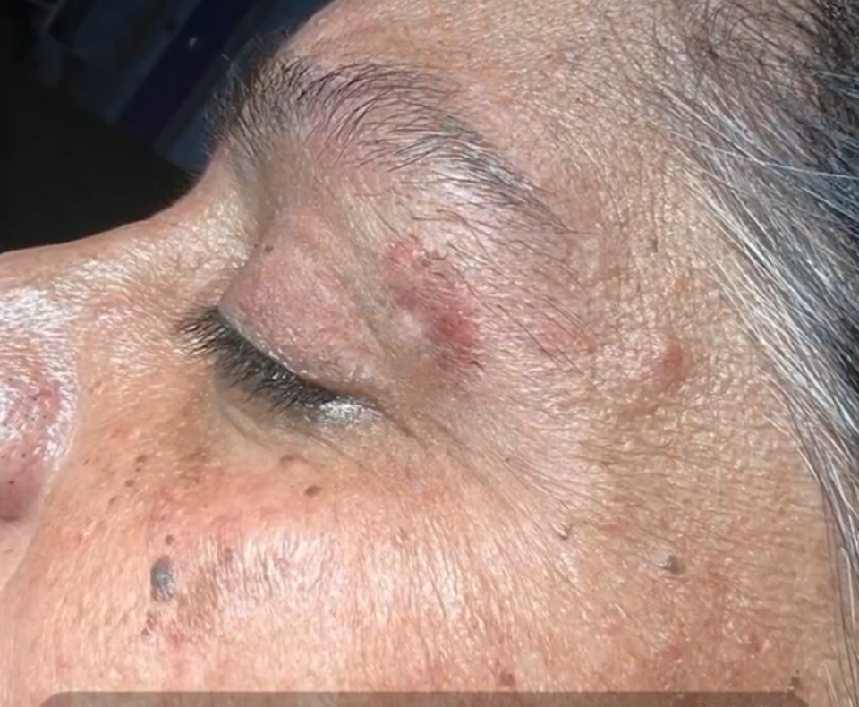 Image of the face after receiving treatment for seborrheic keratosis