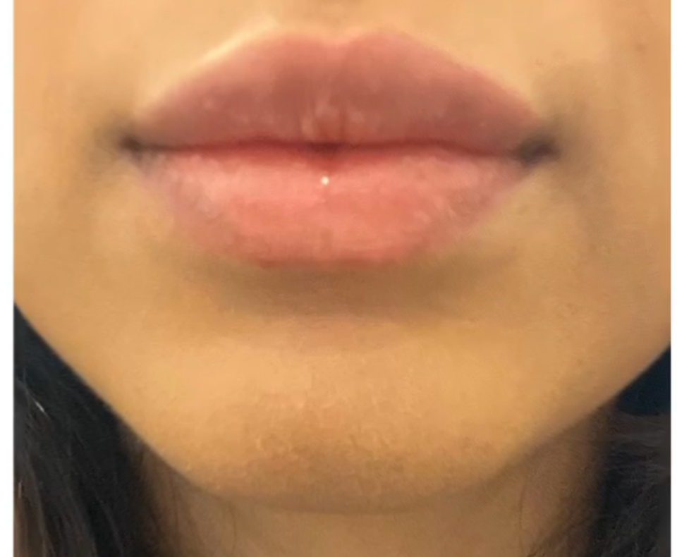 lips of the lady after the surgery