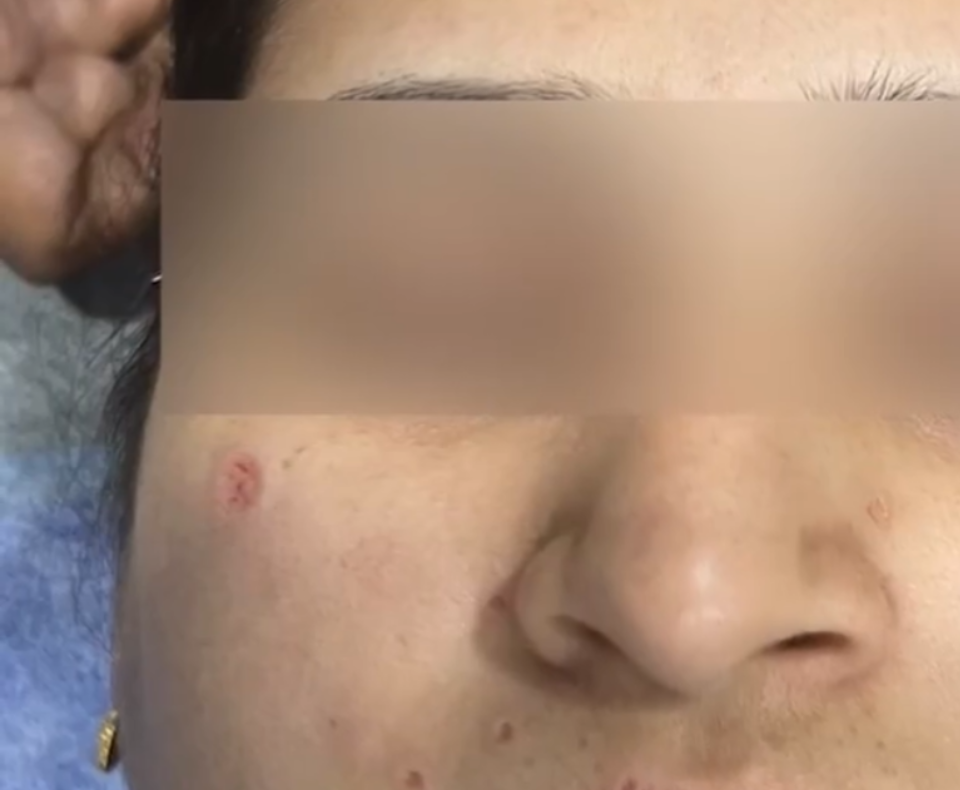 Image of moles on the face after treatment