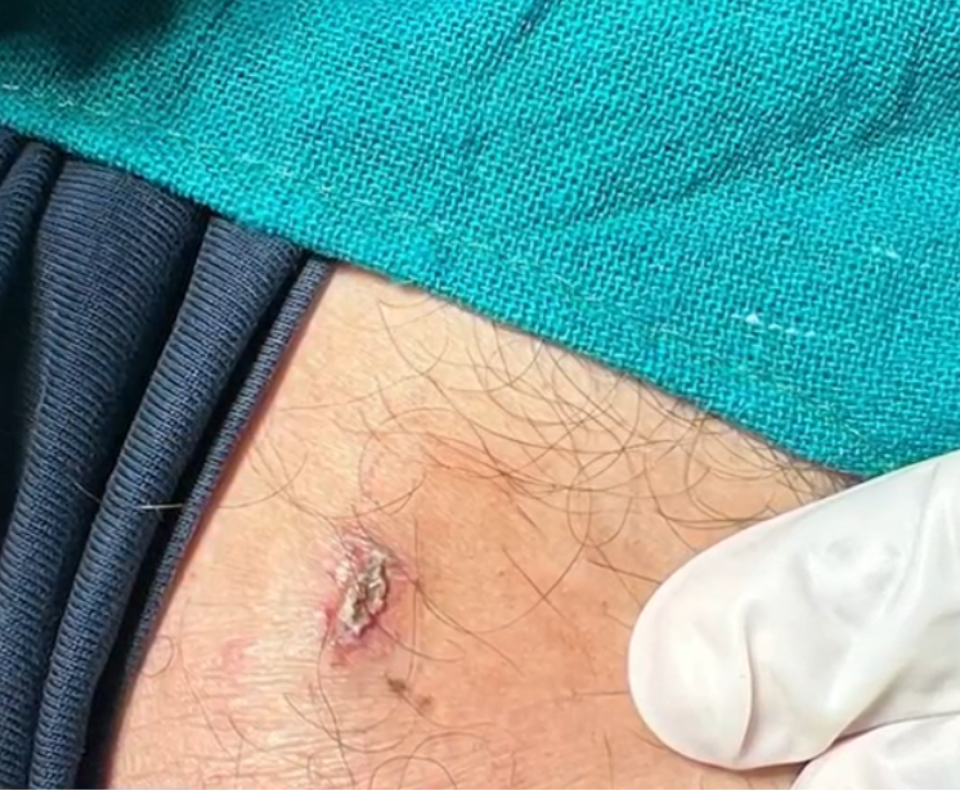 Image of skin infection after treatment