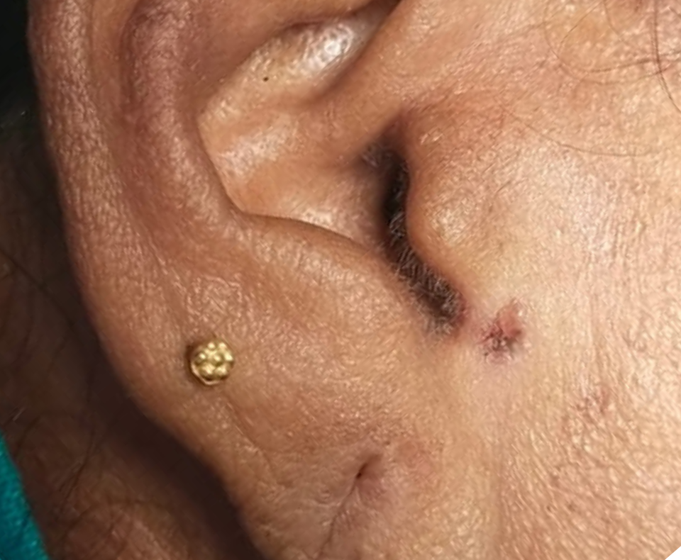 Face image after keratosis treatment