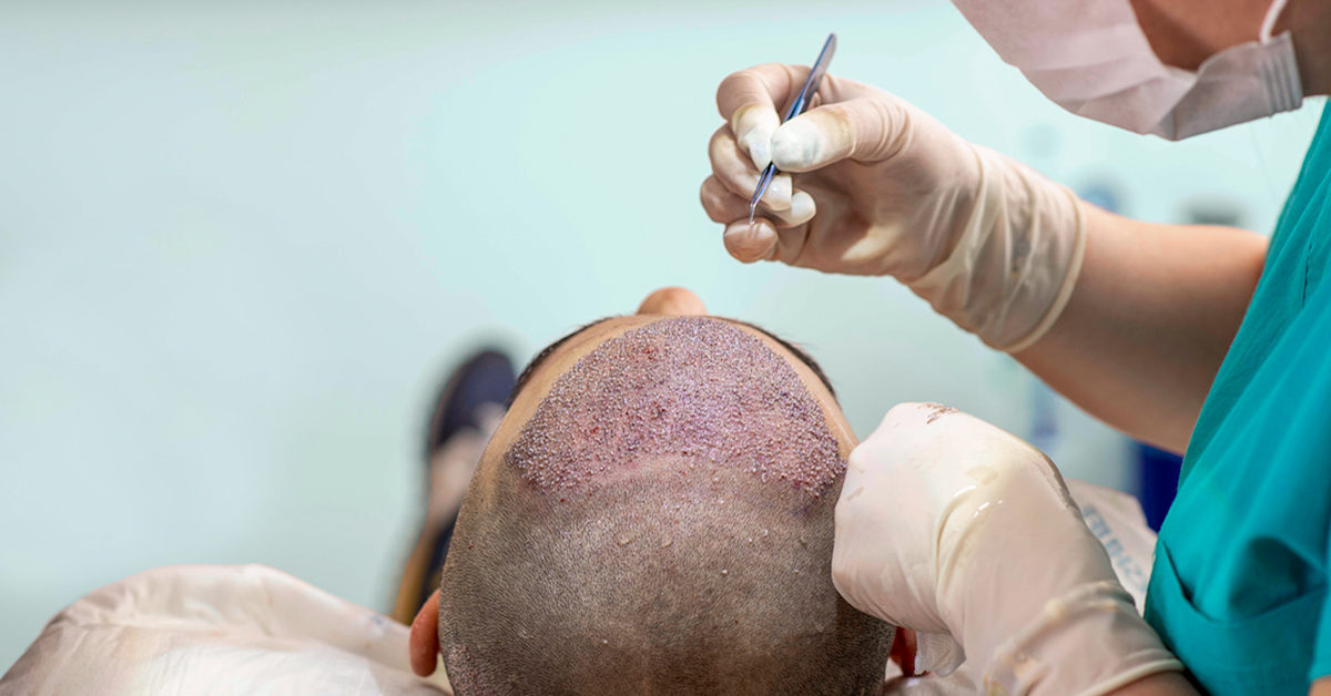 Hair Transplantation