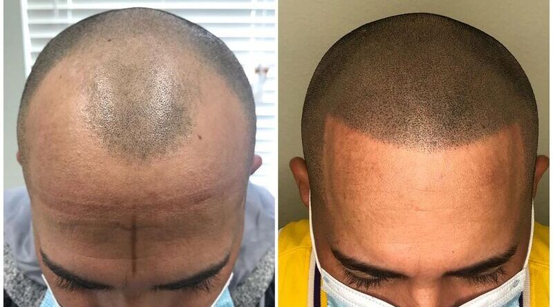 Micropigmentation