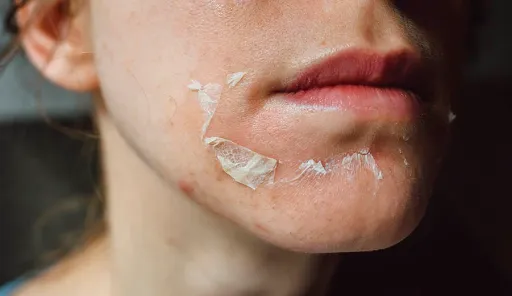 Chemical Peeling