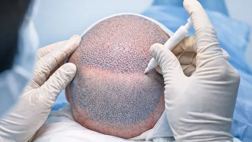 Hair Transplantation
