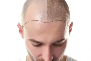 Micro Pigmentation
