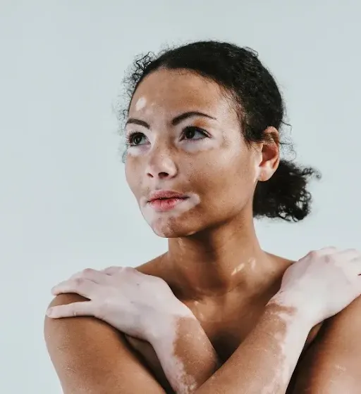Vitiligo Surgery