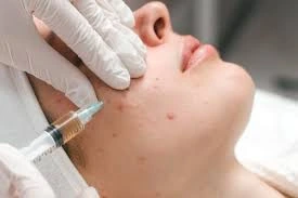 Acne Scar Treatment
