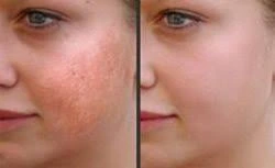 Skin Rejuvenation laser