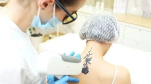 Tattoo Removal